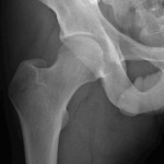 Femur